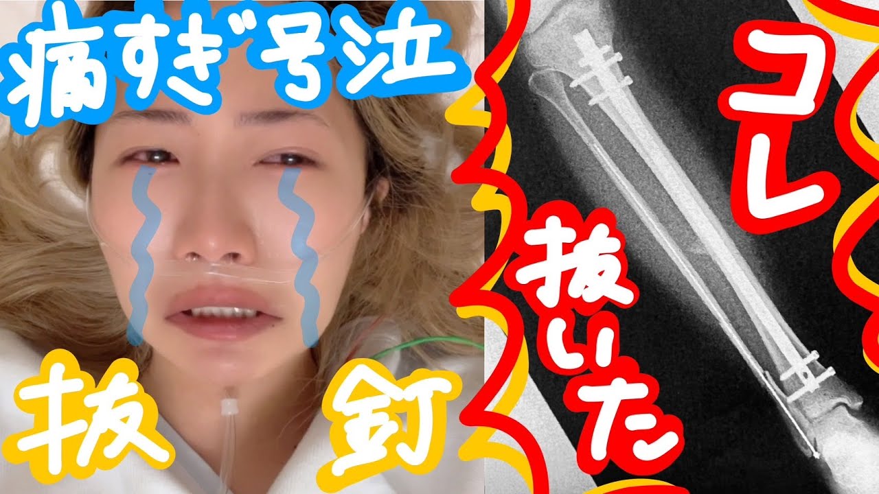 122話 ※閲覧注意【激痛号泣】脛骨・腓骨の抜釘手術を下半身麻酔でやった結果