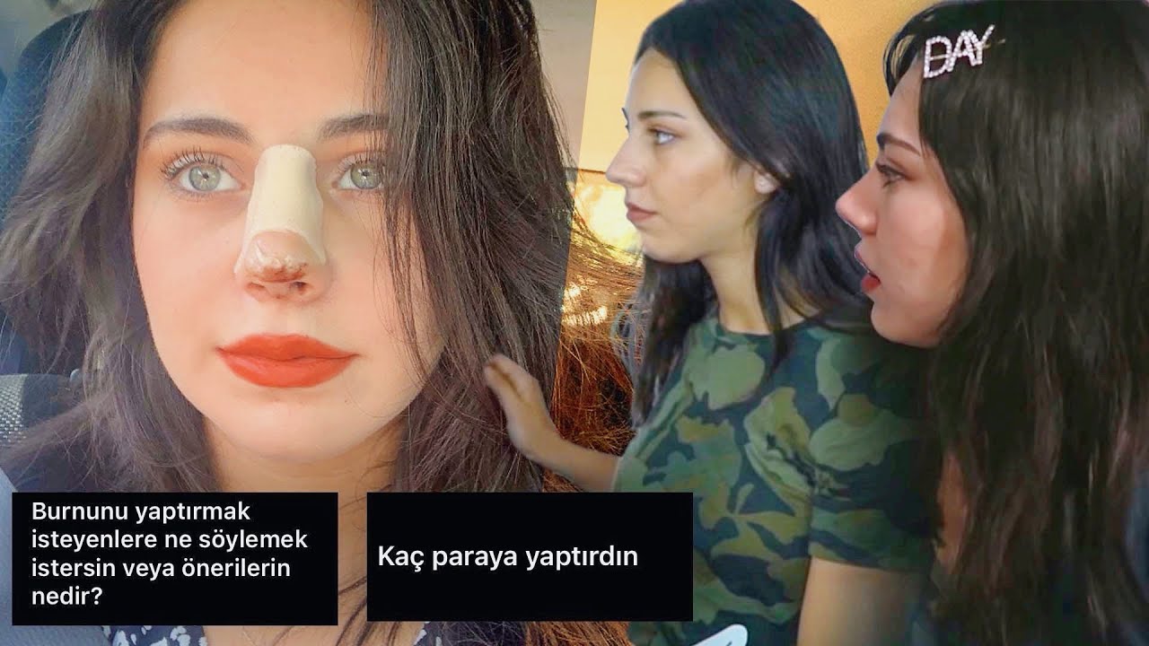 Burun Ameliyatım Hakkında Merak Edilenleri Cevapladım || Pişman mıyım? 👃🏼