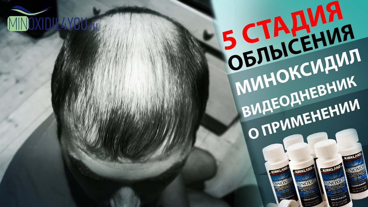 МИНОКСИДИЛ ОТЗЫВ о применении при облысении 5 стадия. Minoxidil4you миноксидил от выпадения волос