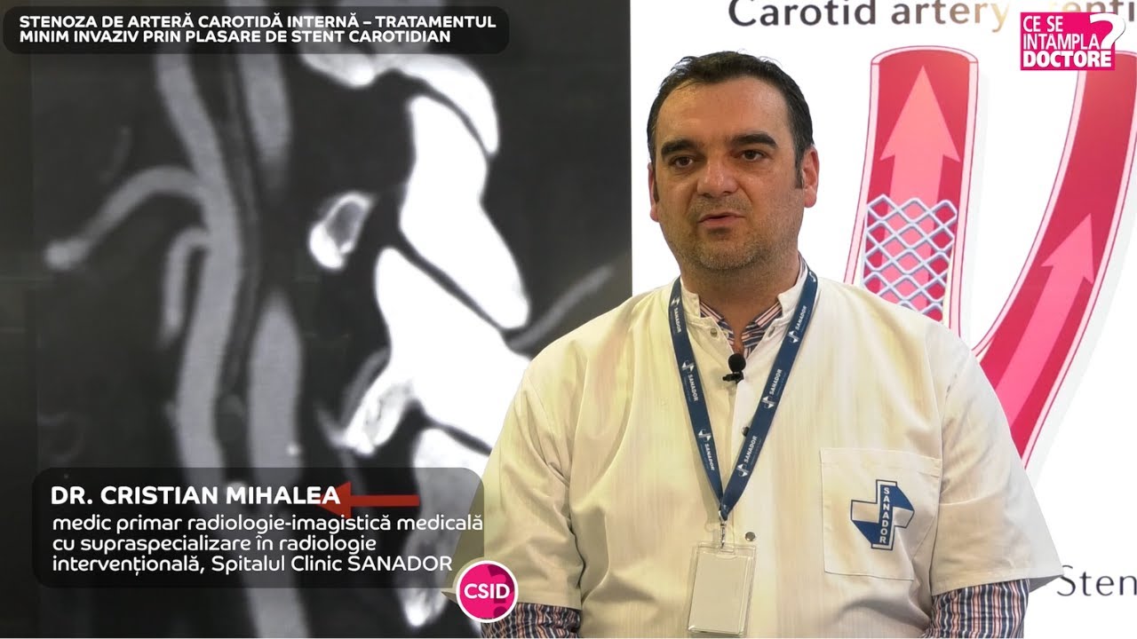 Tratamentul stenozei de arteră carotidă internă – Dr. Cristian Mihalea | Spitalul Clinic SANADOR