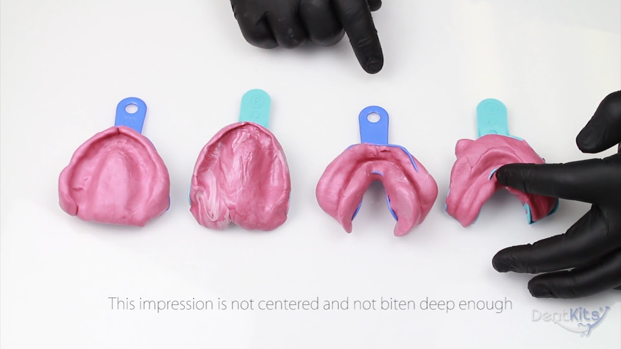 A closer look at Good and Bad Impressions for your DentKits Order