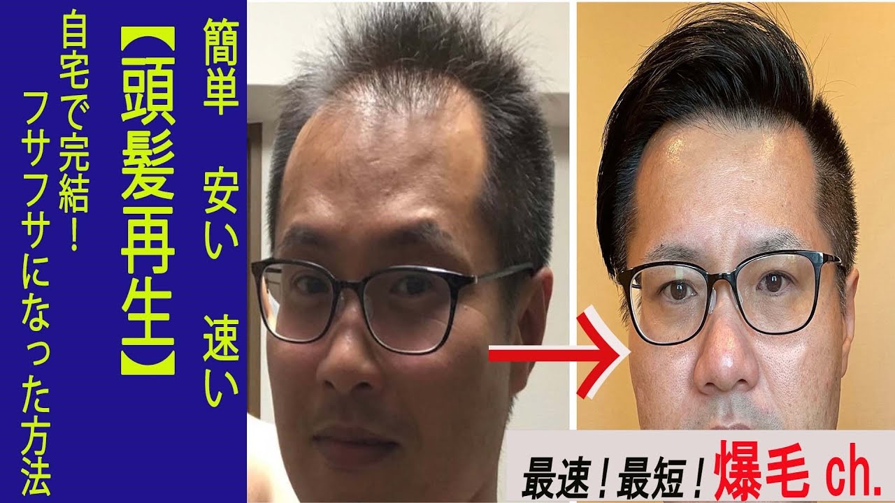 【字幕】ハゲ薄毛脱出した簡単な方法（真似は自己責任で）