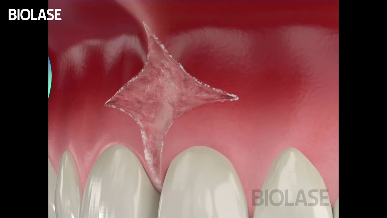 Maxillary Frenectomy