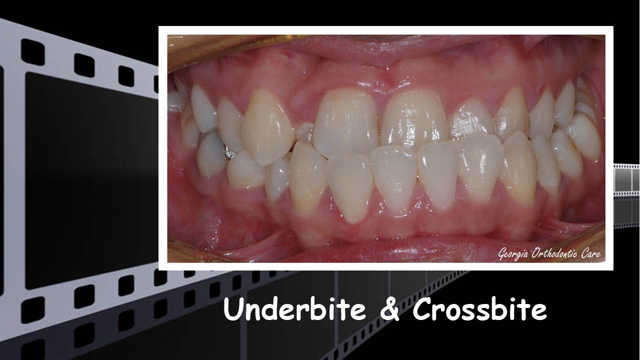 Underbite & Unilateral Crossbite