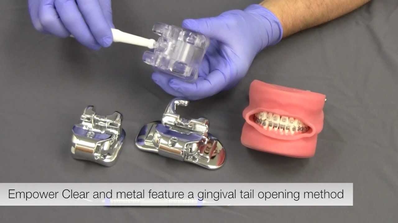 Empower Braces Open-Close Techniques