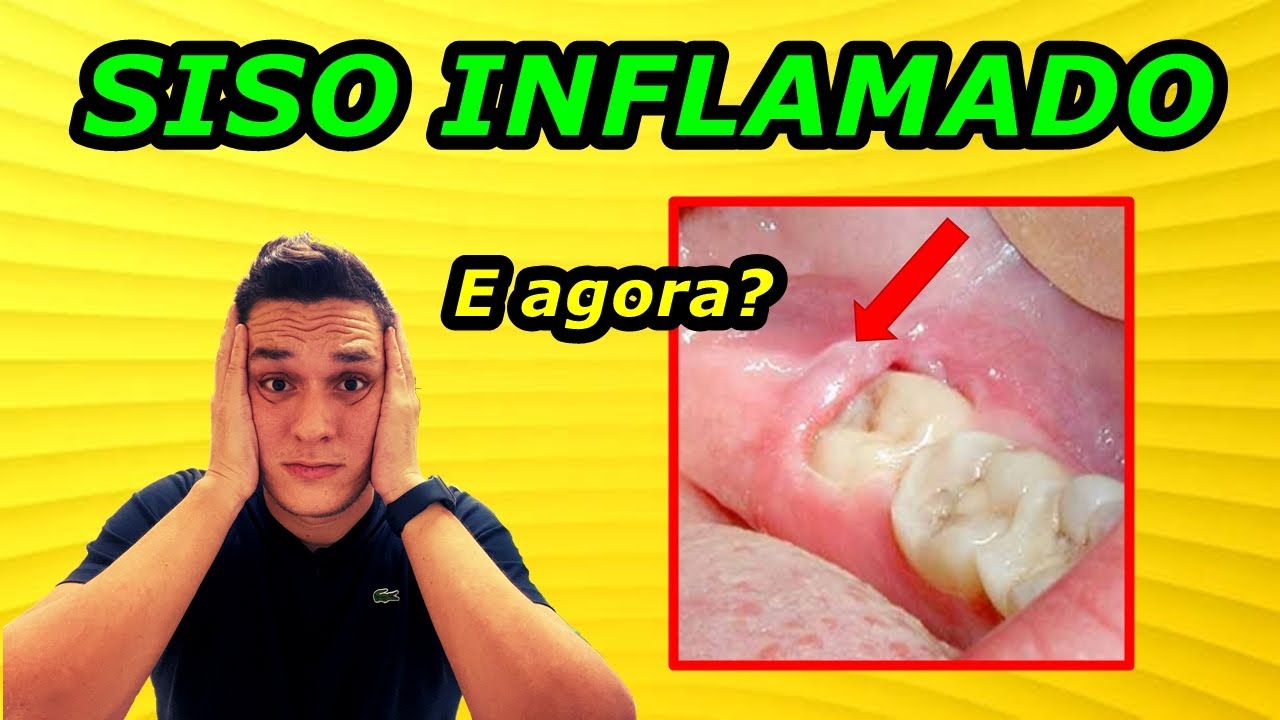 DENTE DO SISO INFLAMADO | O QUE FAZER? | REMÉDIOS CASEIROS!