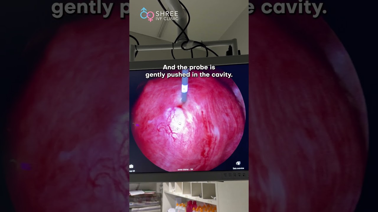How a Tiny Probe Relieved Years of Pain | Adenomyosis Treatment Story! | Dr Jay Mehta, Mumbai