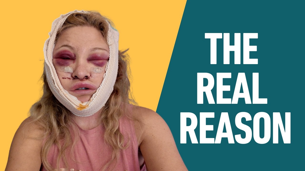 Why I Got a Facelift at 47 - When People Say I Didn't Need it (Answering Your Questions)