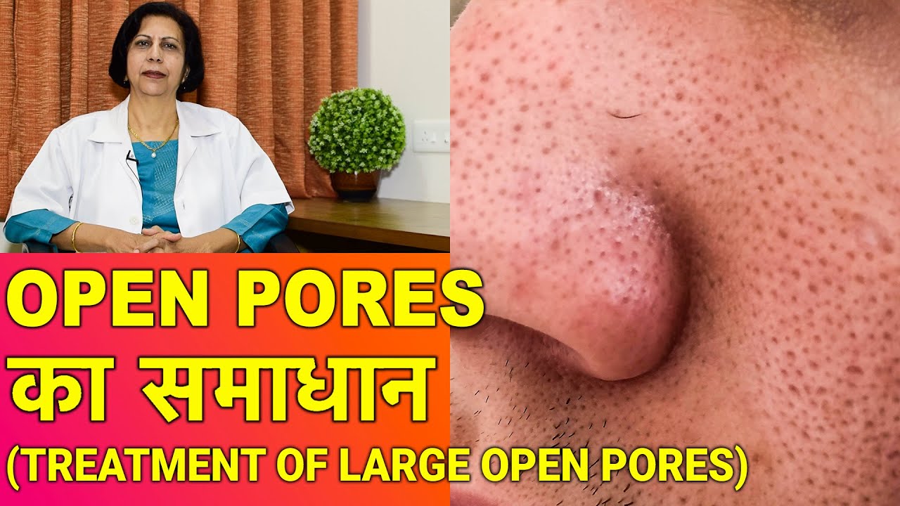 ओपन पोर्स का ईलाज || Open Pores Treatment