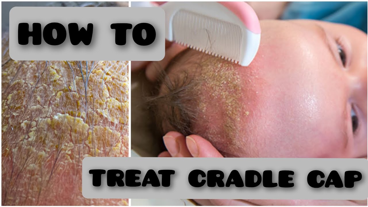 How to Treat Cradle Cap.Newborn baby. #newborn #cradlecap