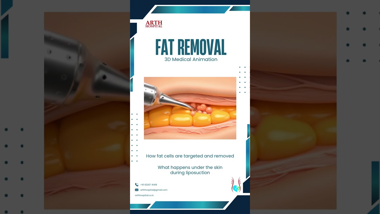 Liposuction Explained | How Fat is Removed (3D Medical Animation)