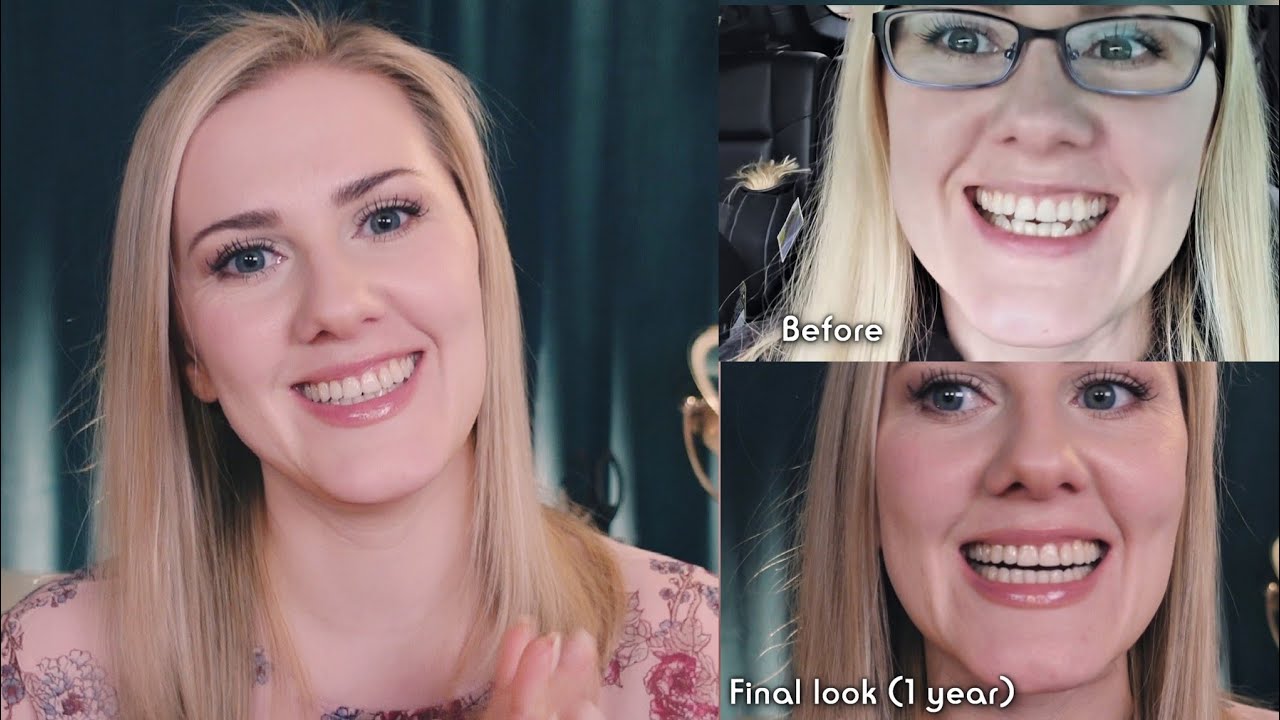 INVISALIGN Transformation 👄 Final Look