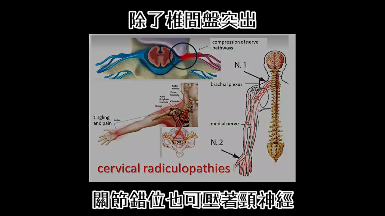 頸第一二節關節錯位將近一年....