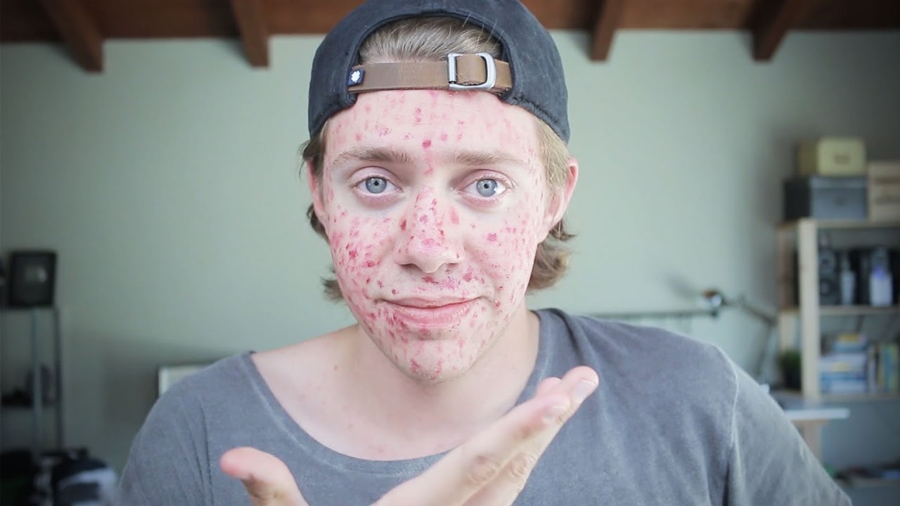 How I Cured My Acne