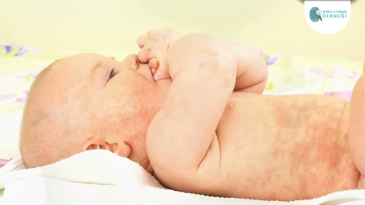 Atopik dermatit nedir?  Kimlerde, hangi yaşta görülür?