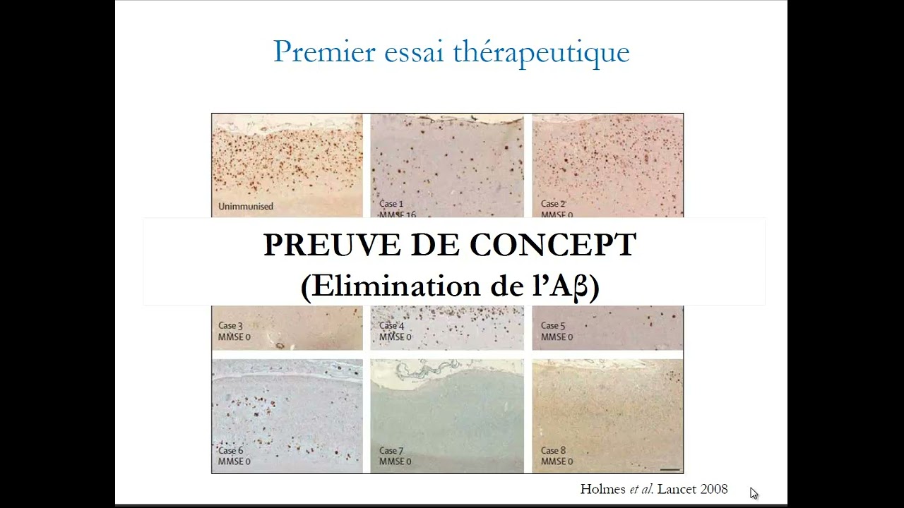 Développement anti amyloïde de la Maladie d'Alzheimer