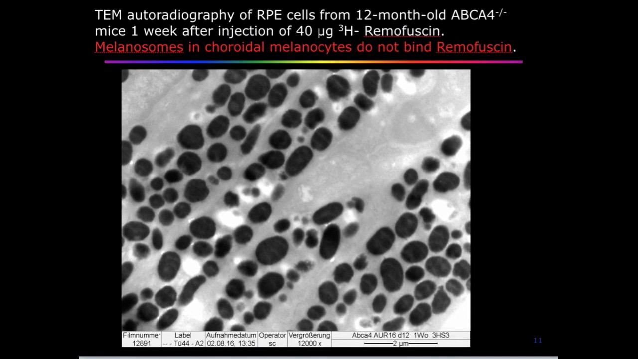 New therapy option for dry age related macular degeneration and Stargardt&acute;s disease 18 7 2017