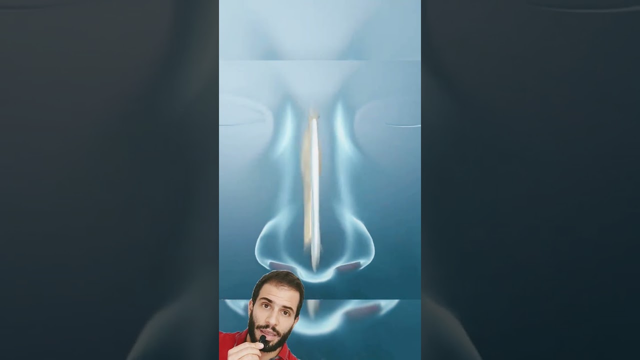 👃➡️&iquest;Tienes. tabique nasal desviado? Te interesa est&aacute; cirug&iacute;a ✅(SEPTOPLASTIA)