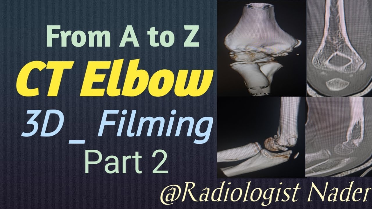 اشعة مقطعية علي مفصل الكوع|الجزء الثاني|3D|طباعة|CT Elbow Joint|Part2|3D|Filming