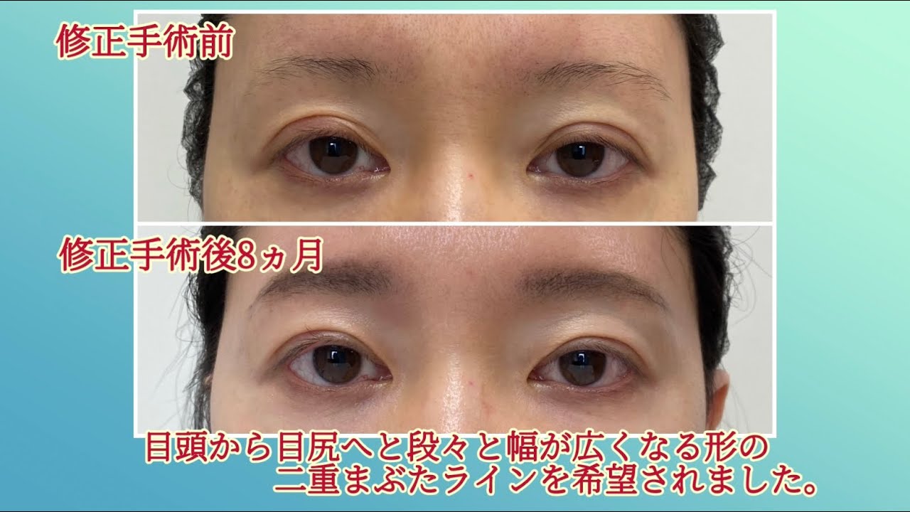 二重まぶたライン幅を狭くする。目頭近くの目の開きがよくなっています。