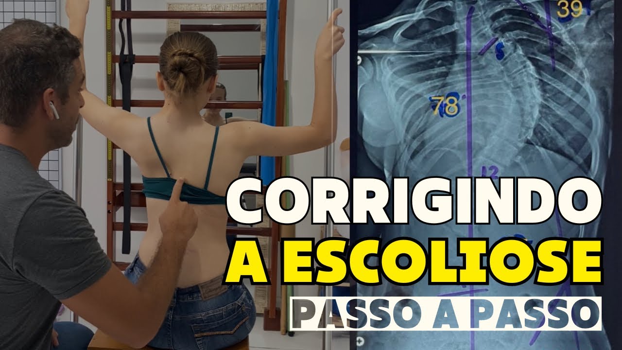 TRATAMENTO DA ESCOLIOSE PASSO A PASSO
