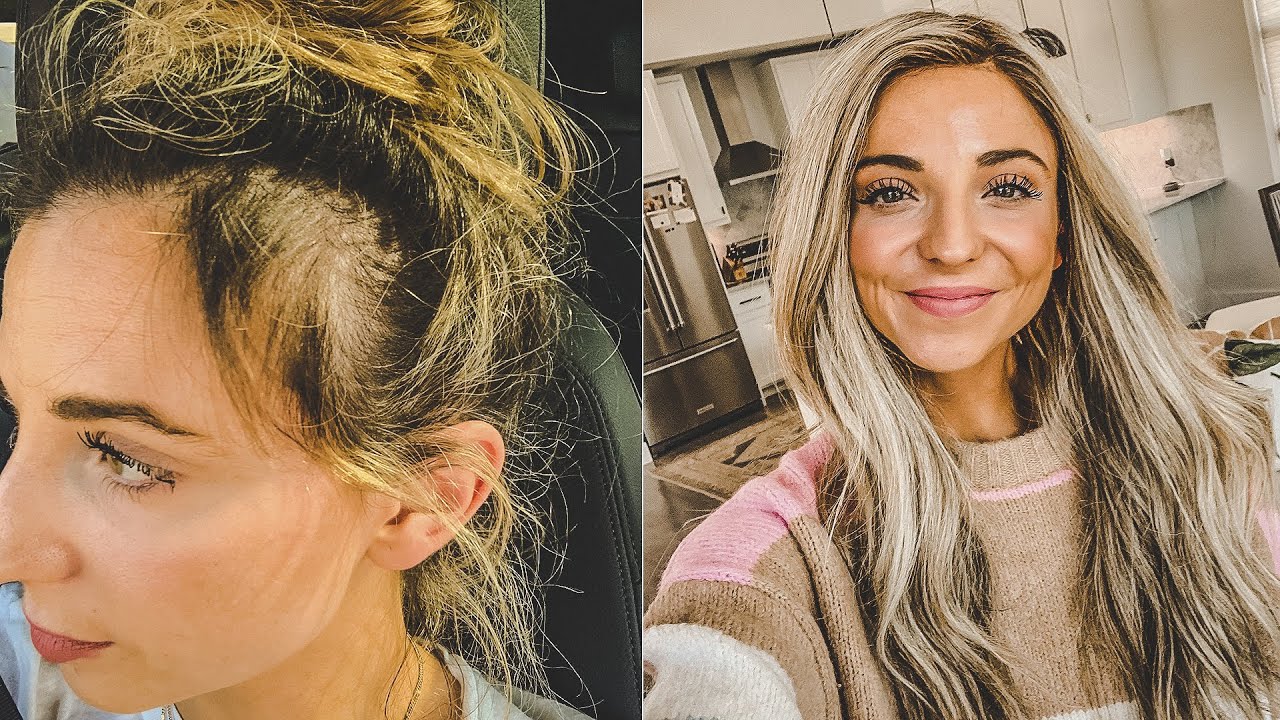 I started losing my hair in my 20s, here's how I grew it back
