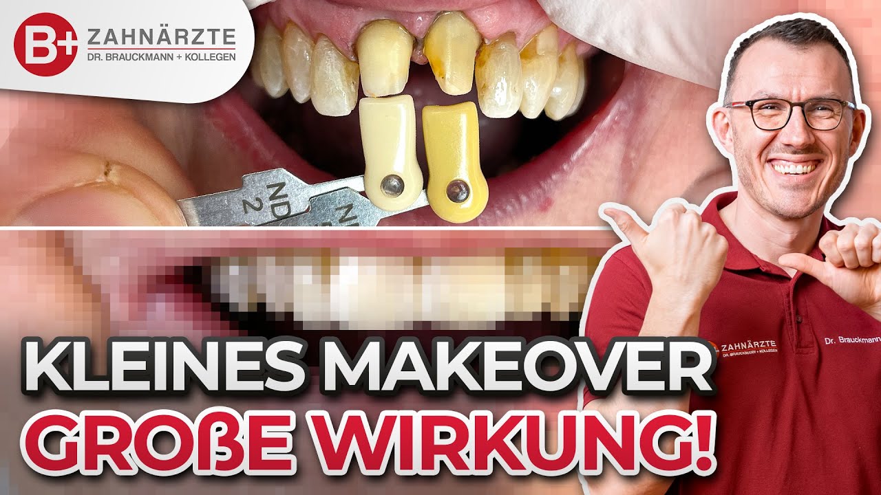 2 neue Frontz&auml;hne | Kleines Makeover mit enormer Wirkung! Zahnkronen im Labor gefertigt!