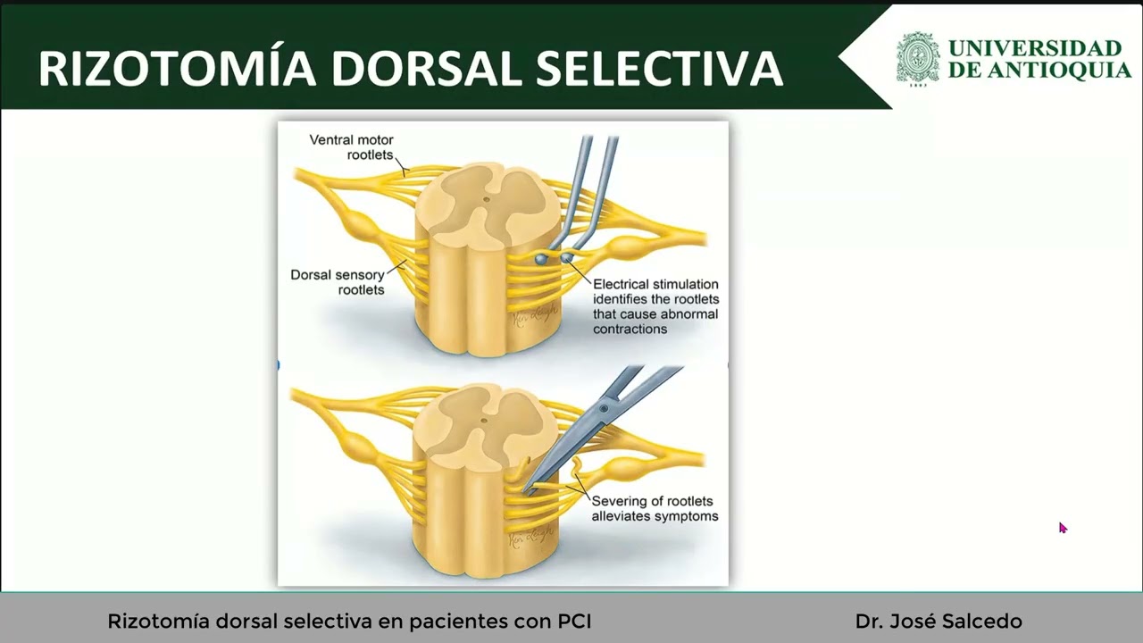 Rizotomía dorsal selectiva en pacientes con PCI