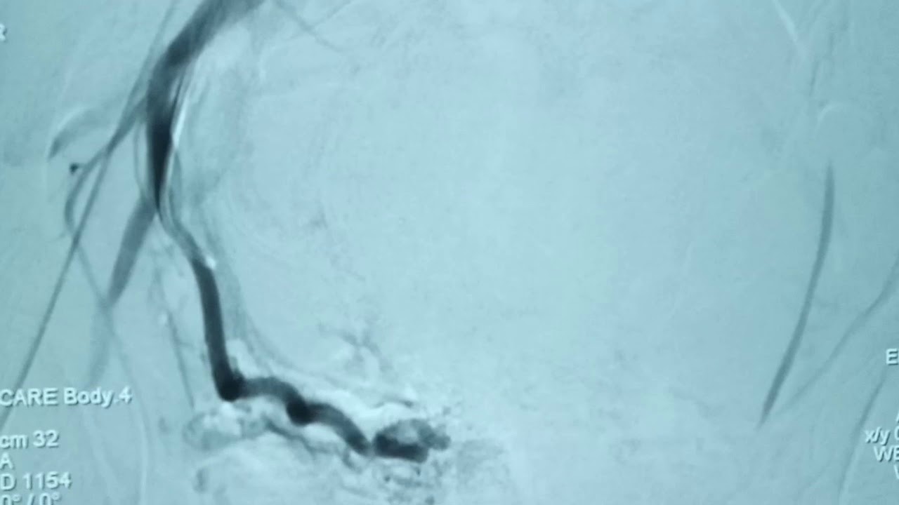 Direct Intrahepatic Portosystemic Shunt (DIPSS) /  Transjugular Intrahepatic Portosystemic Shunt