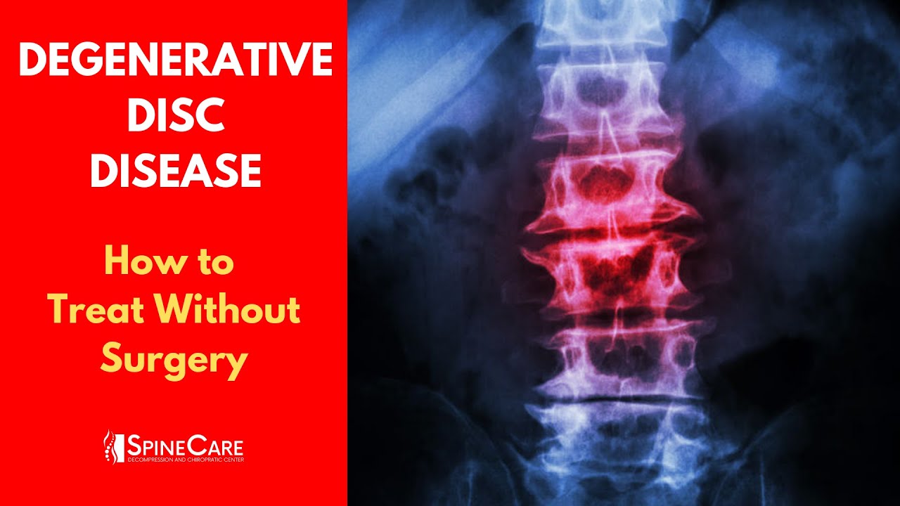What is DEGENERATIVE DISC DISEASE? | How to Treat It WITHOUT SURGERY