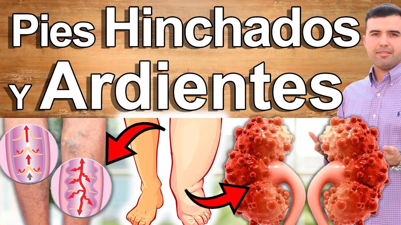 Porque Me Arden o Hinchan Los Pies? - Causas Y Soluciones Para Eliminar El Edema Y Ardor De Pies