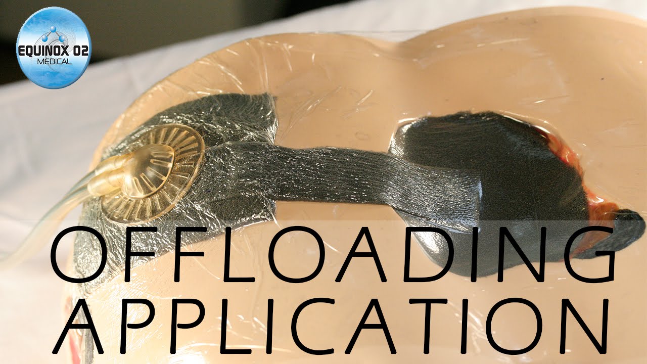 NPWT Black Foam Wound Dressing Kit  Offloading Application by Holly Desimone @ Equinox Medical