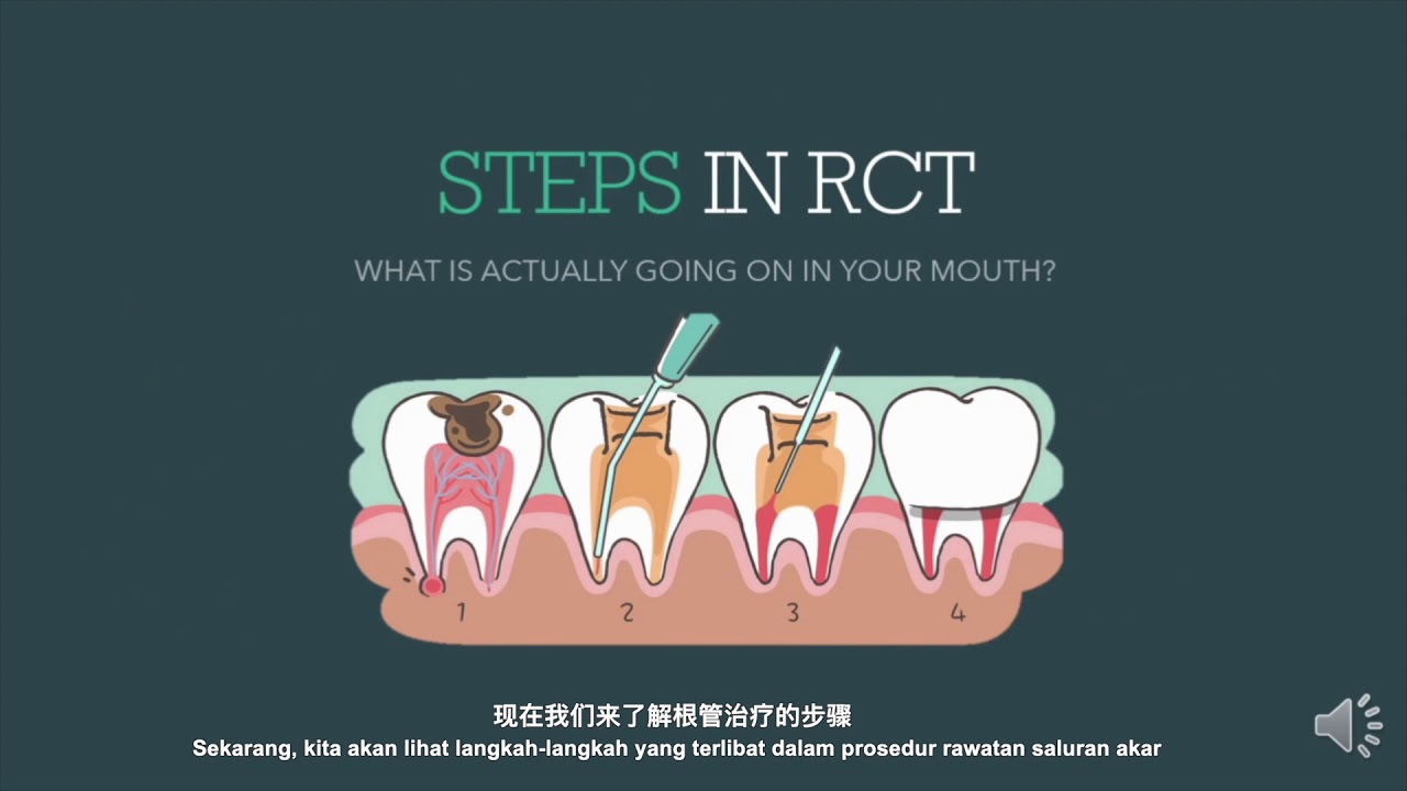 ROOT CANAL TREATMENT (RCT) and Post & Core 3