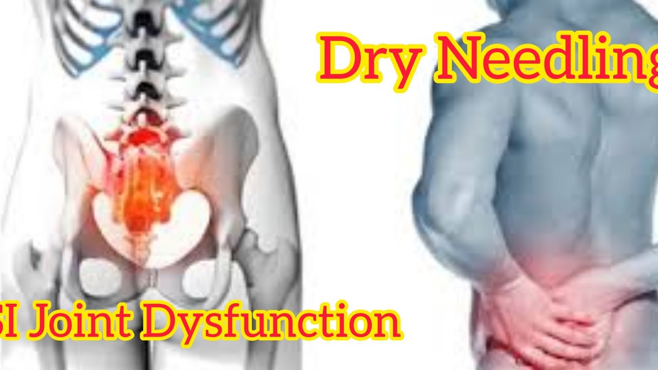 Dry Needling | SI Joint Dysfunction  | Dr Hardik Patel | Ahmedabad | 8980 676 676