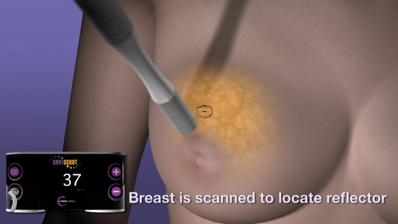 Making Breast Surgery Easier with SAVI SCOUT&reg;