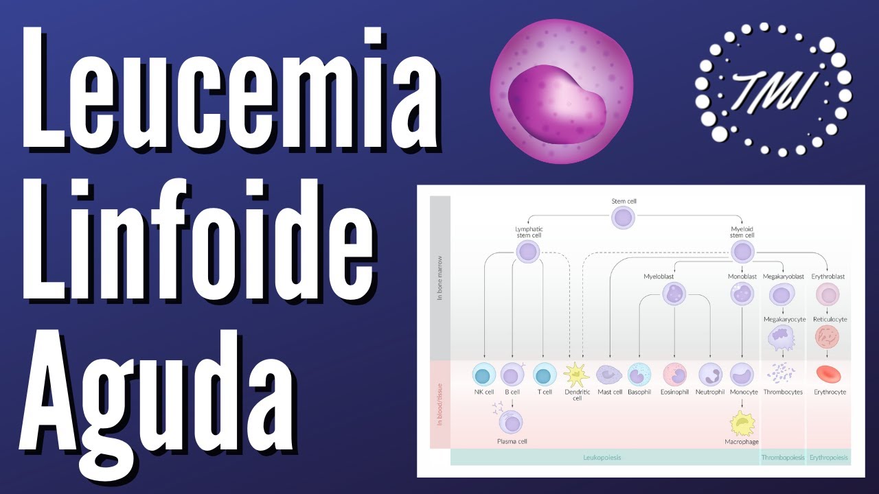 Leucemia Linfoide Aguda Explicada Claramente