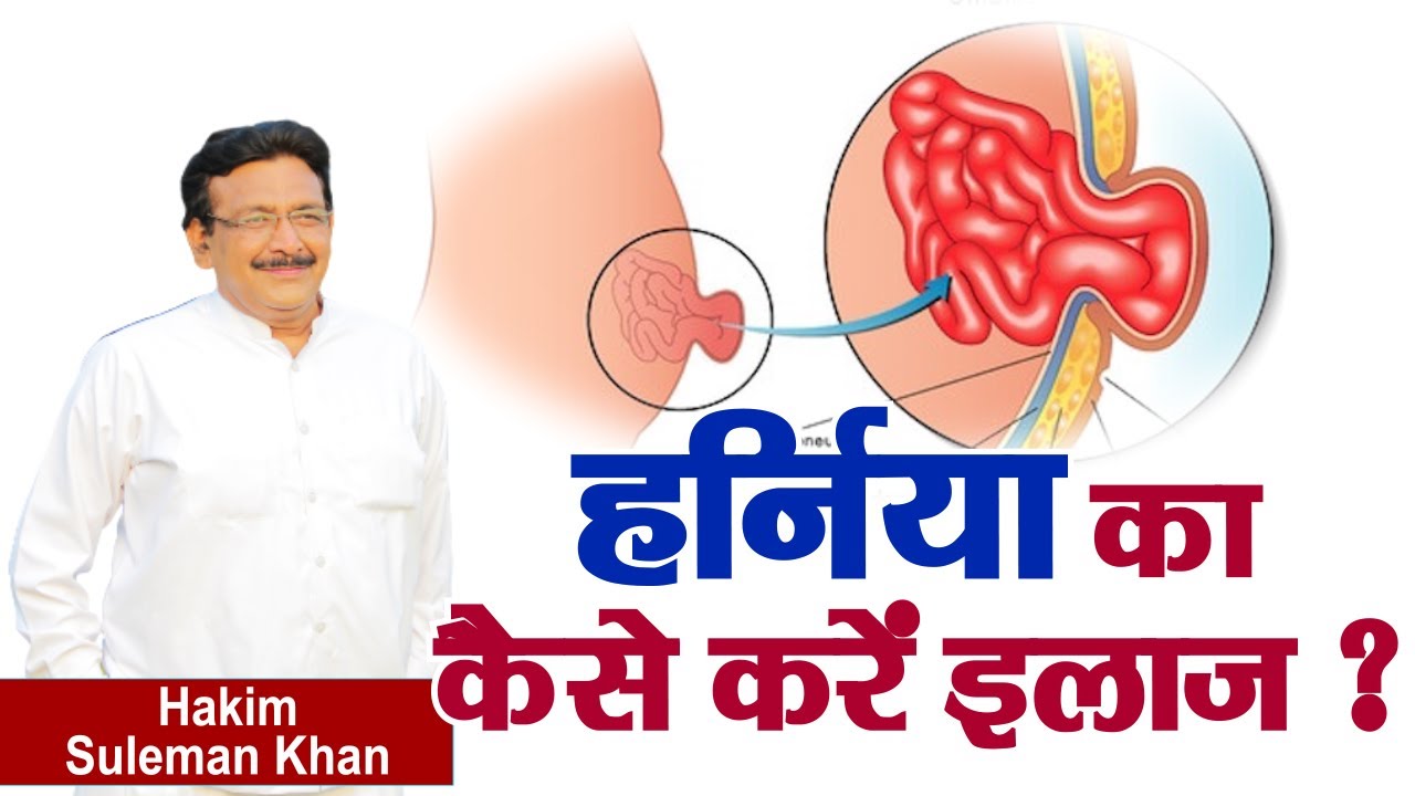 हर्निया का कैसे करें इलाज ? Hernia | Hakim Suleman Khan | Sadhna TV