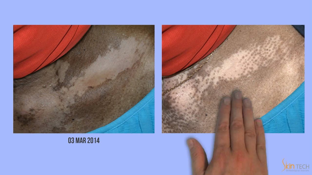Vitix Gel for Vitiligo - Norpharm