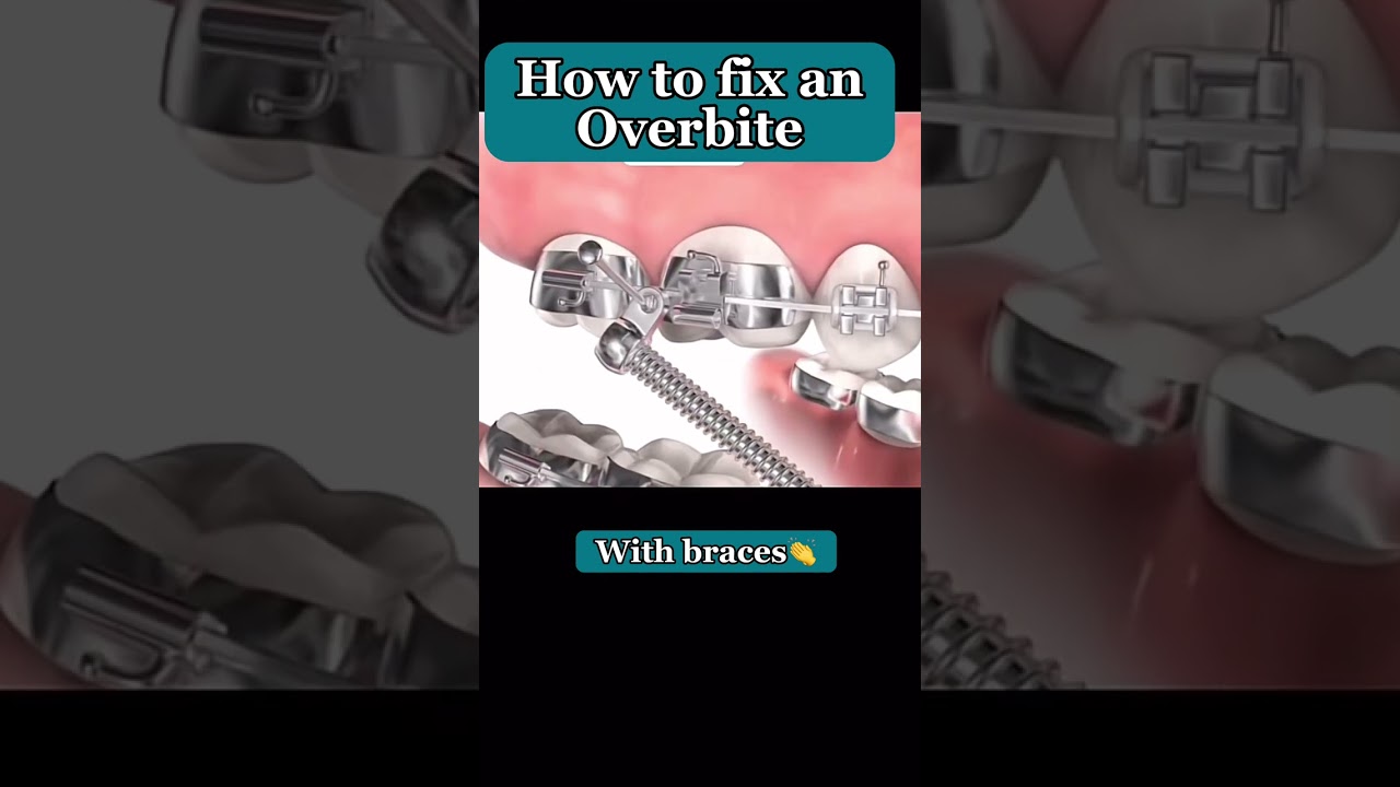 Overbite Correction #shorts