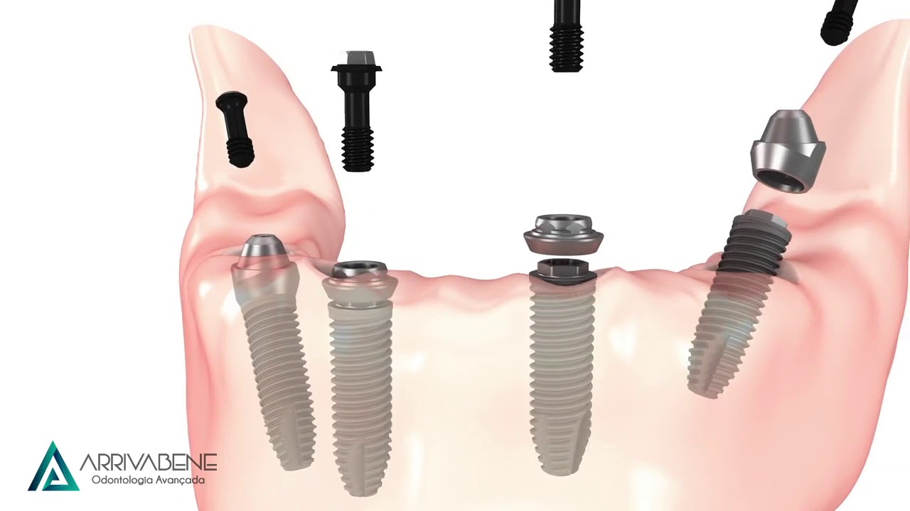 Anima&ccedil;&atilde;o T&eacute;cnica All-on-4 - Arrivabene Odontologia