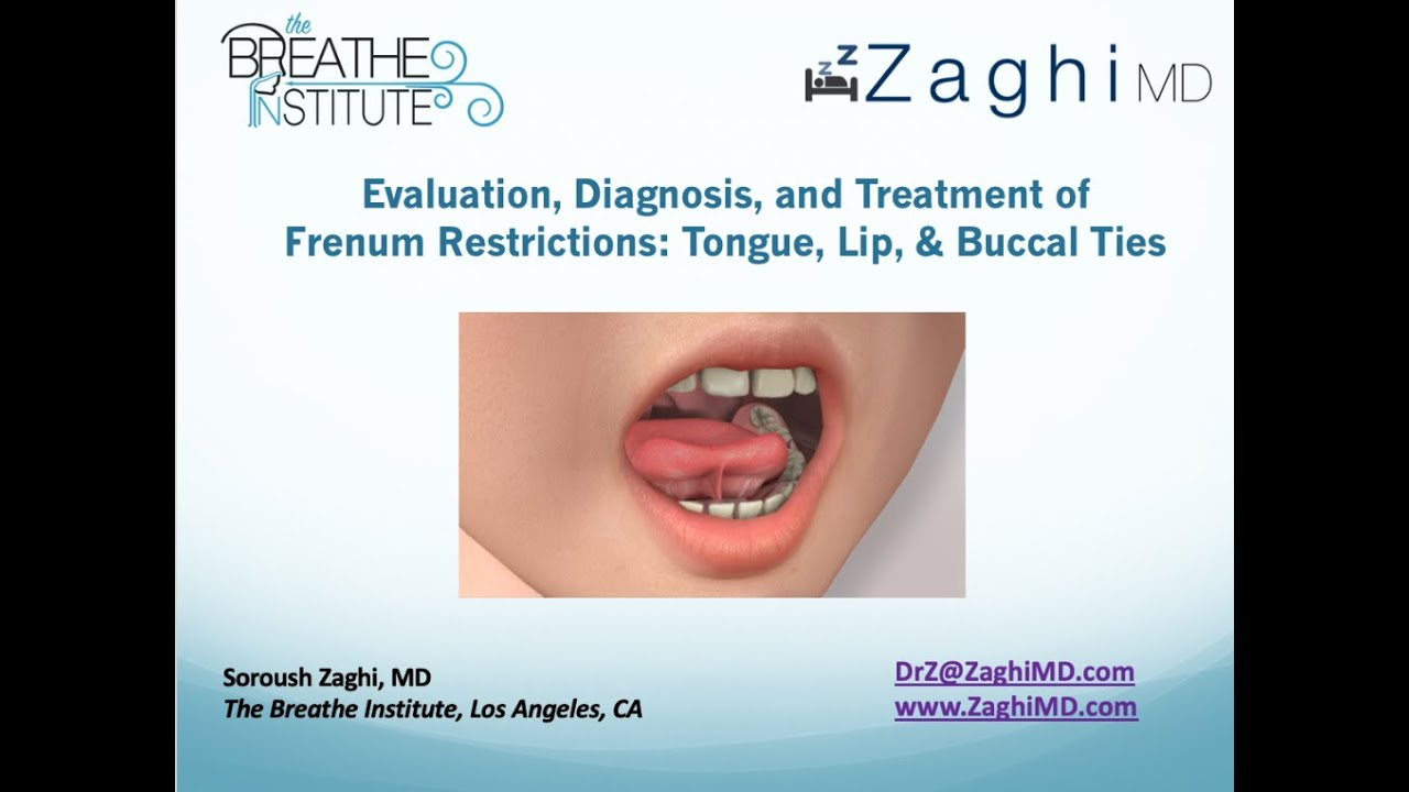Full Lecture: Evaluation, Diagnosis, and Treatment of Tongue, Lip, & Buccal Ties, Dr. Soroush Zaghi