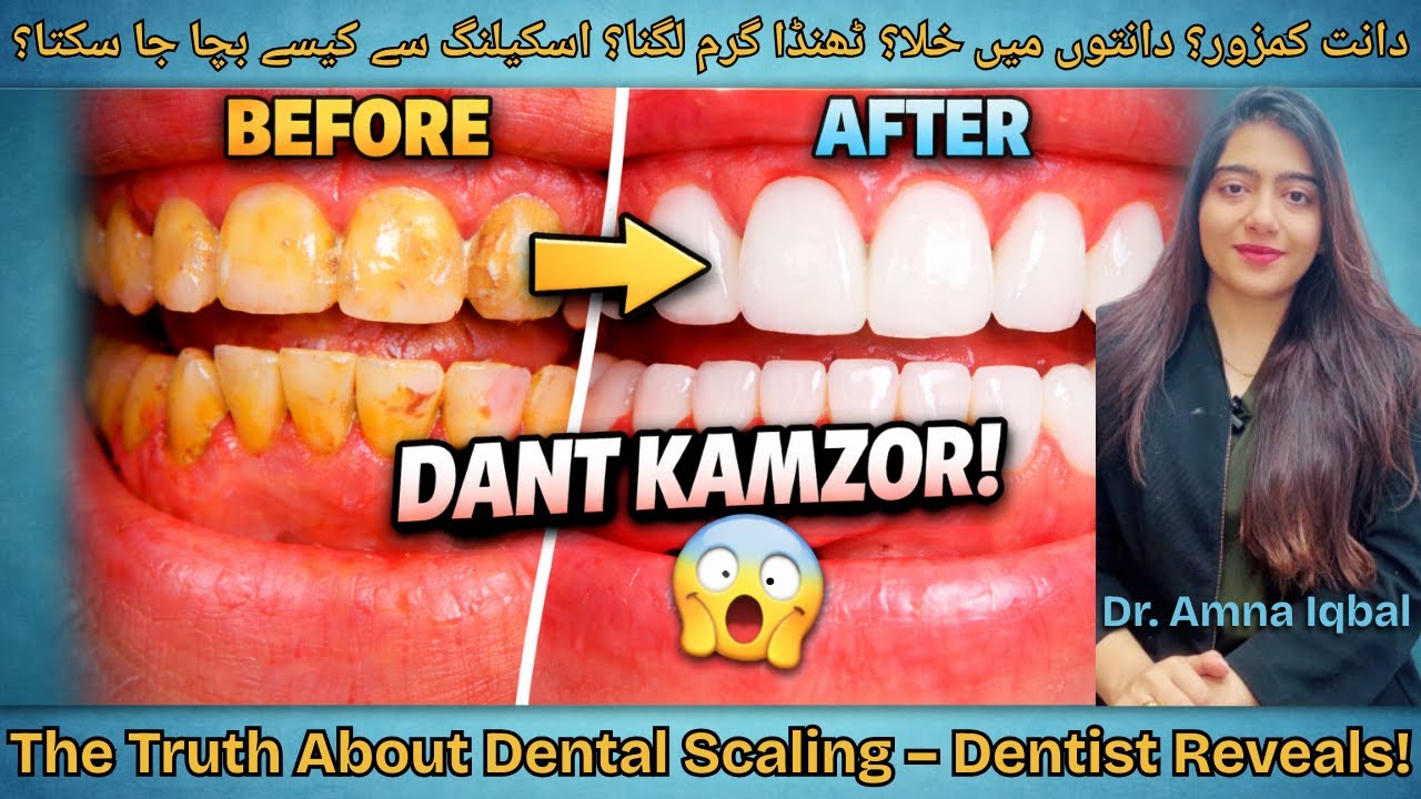 Dental Scaling Damage Your Teeth? Kya Dental Scaling Safe Hai? #dentist #teethcleaning #scaling