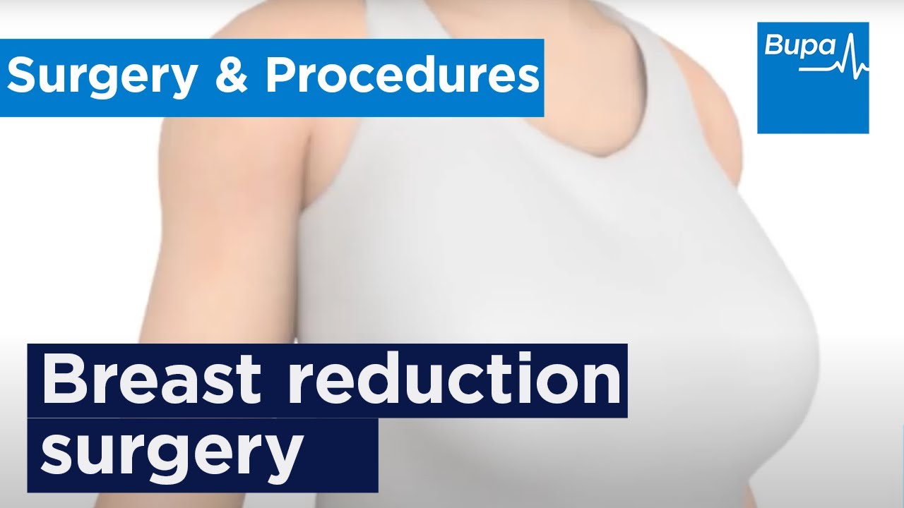 How breast reduction surgery is carried out | Bupa Health