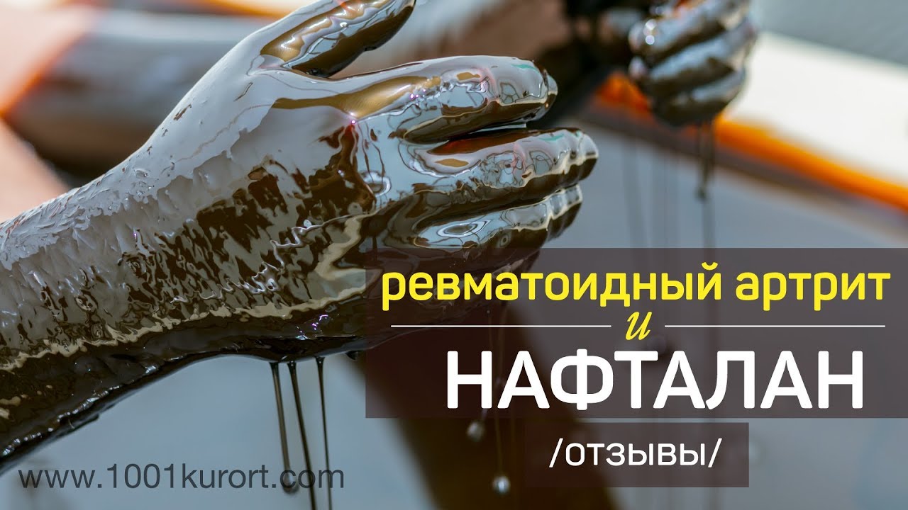 Ревматоидный артрит и Нафталан. Как избавиться от боли в суставах. Отзывы пациентов.