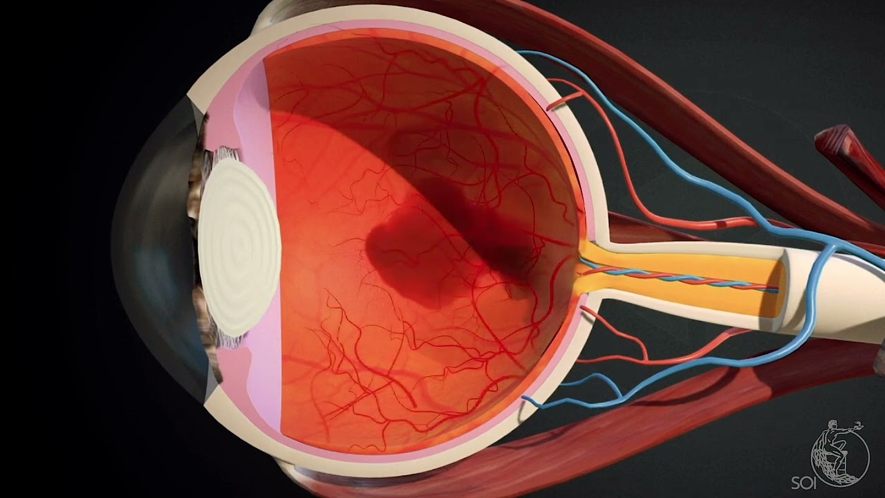 PUCKER MACULARE E MEMBRANA EPIRETINICA - Dott. Filippo Confalonieri   cause, sintomi e terapie