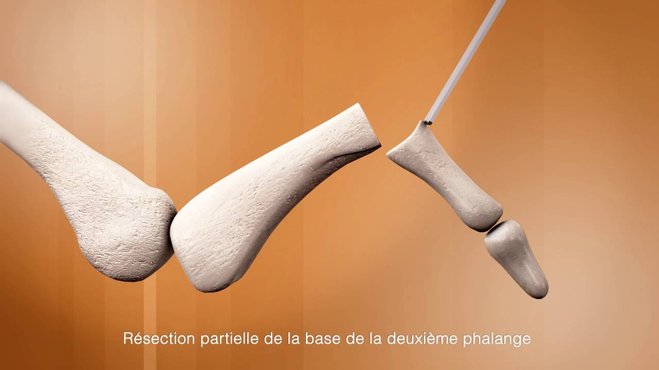 Dr. Coillard | Dr. Boublil | Dr. Grisard - Traitement des orteils en griffes par fusion