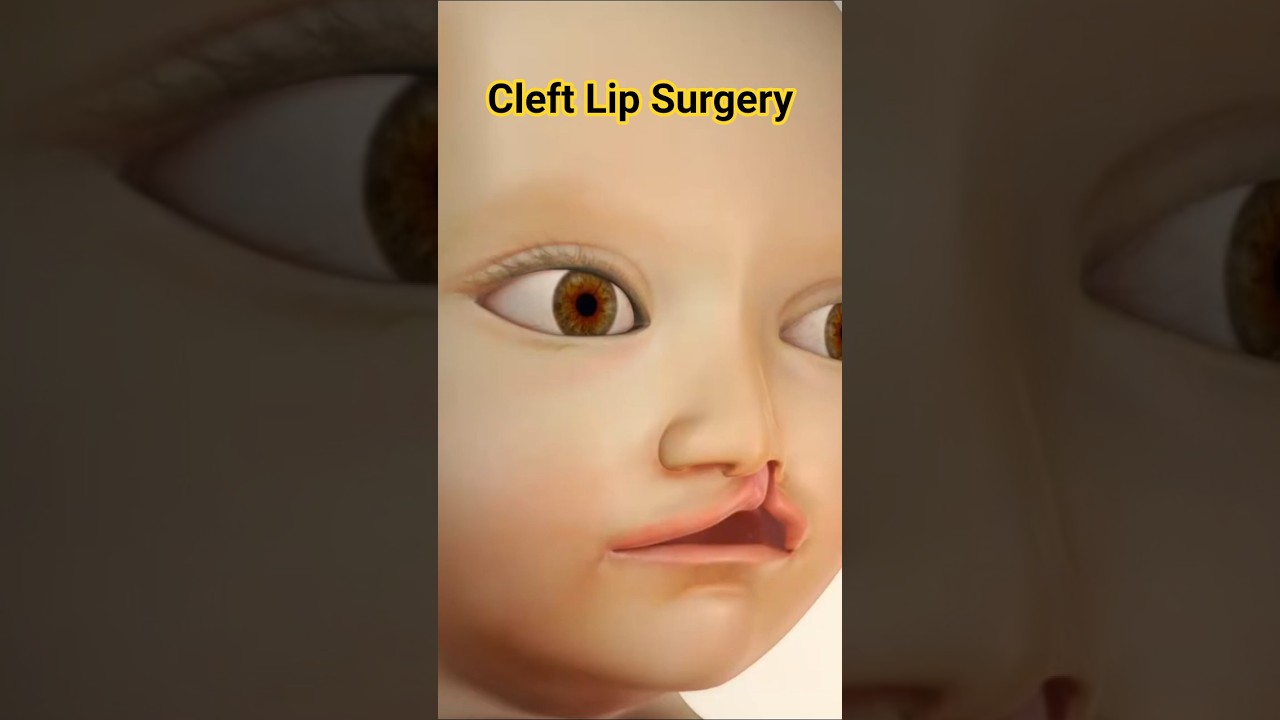 How Cleft Lip Surgery Works | Life-Changing Repair in 20 Seconds