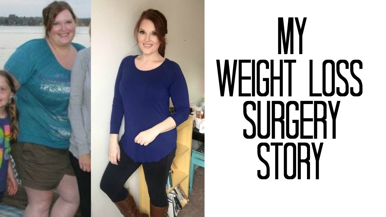 How & Why I lost over 100 lbs with VSG Weight Loss Surgery