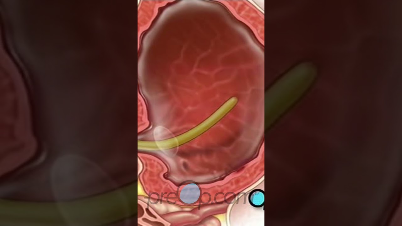 👀 Cystoscopy: What to Know #shorts #preop #health PreOp® Patient Education Pt. 2