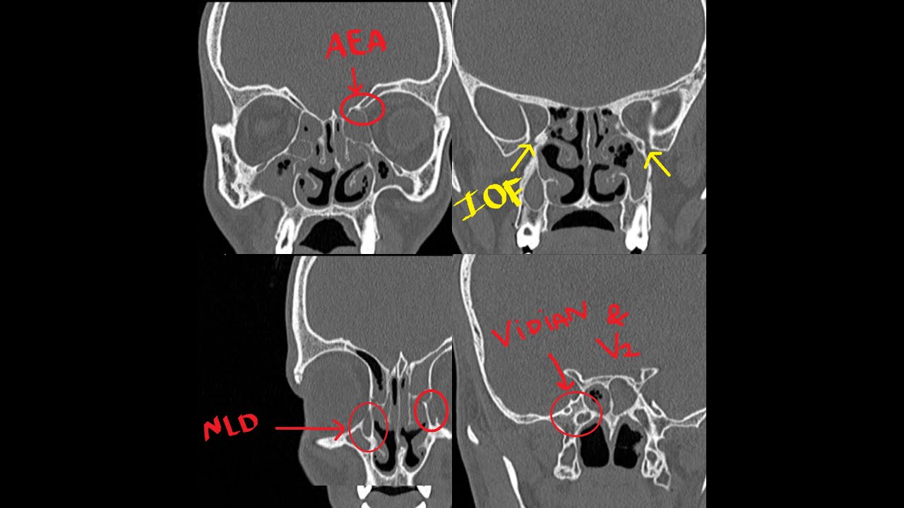 E.N.T PRACTICAL EXAM VIVA /SPOTTERS. Questions asked in VIVA exam.HOW to read a CT SCAN PNS.